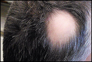 Researchers to conduct study on rezpegaldesleukin for severe, very severe alopecia areata